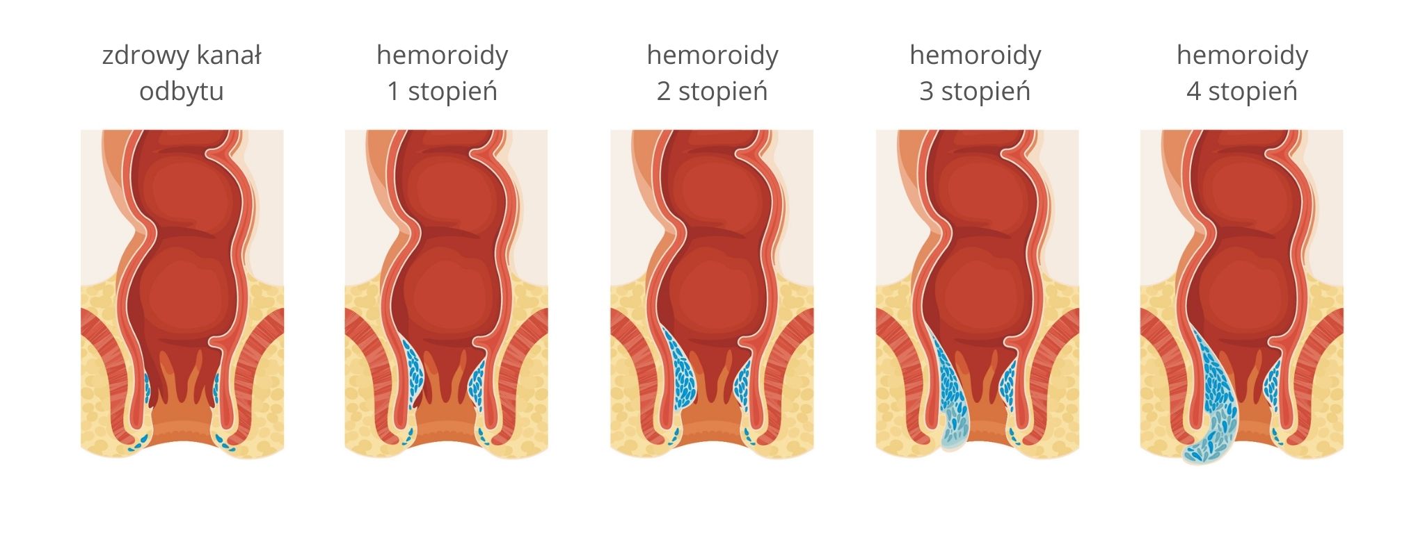 hemoroidy rozwój